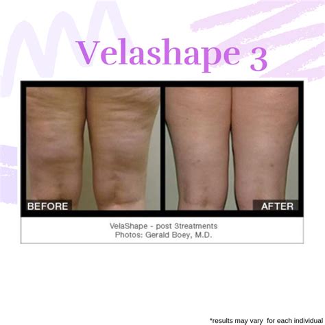 Velashape: Cellulite Treatment .